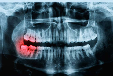 Simple Extraction With Xray (1)