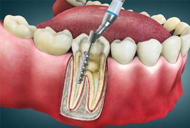 Root Canal