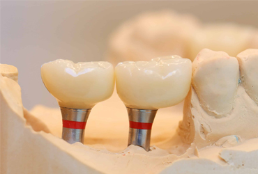 Zirconia Crowns